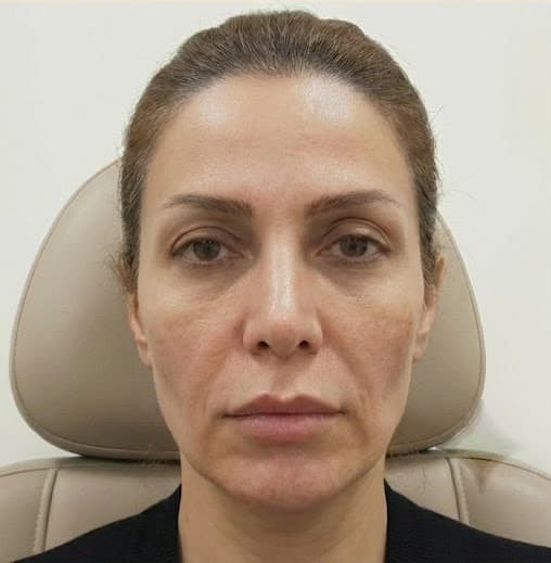 Non-surgical Cosmetic Treatments before treatment result at IranElaj